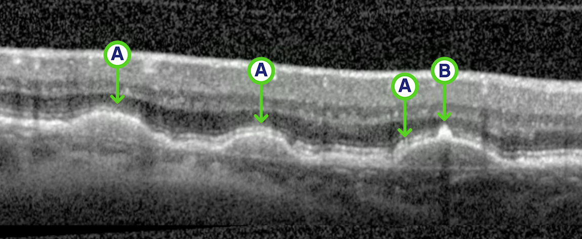 Intermediate AMD